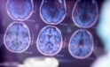 Beyin hücrelerinde "mikroplastik" tespit edildi – Haberler